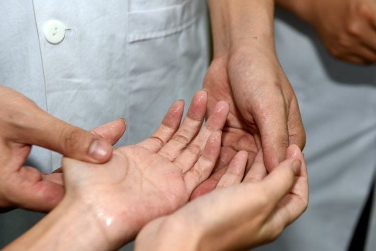 Continuous sweating of hands and feet can be caused by autonomic nervous system disorders
