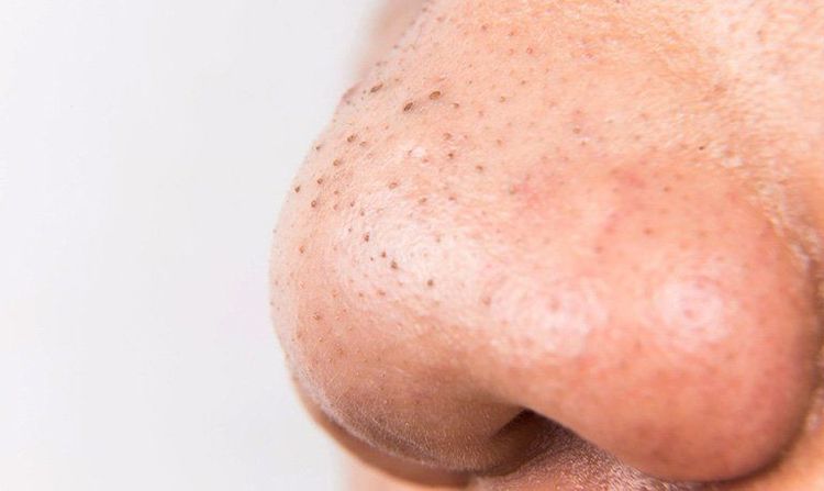 
Mụn đầu đen để lâu không trở thành nốt ruồi
