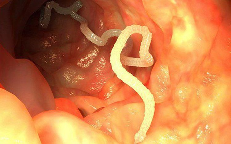 Failure to Gain Weight Due to Parasites Affecting Absorption