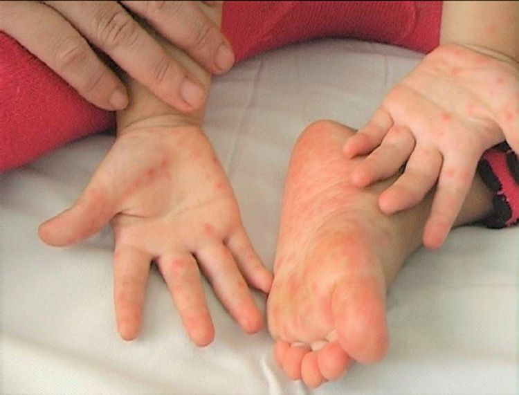 Bệnh chân tay miệng là bệnh ở trẻ sơ sinh thường gặp