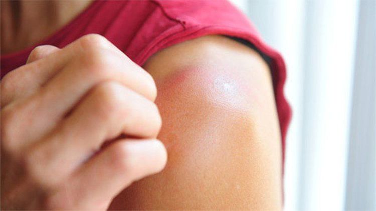 Sunburn-induced pruritus may occur several days after sunburn.