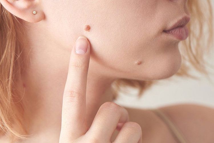 Types of moles that should be carefully examined when they appear abnormal