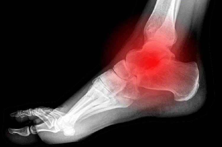 Chụp X-quang để chẩn đoán chính xác nhất về bệnh viêm khớp cổ chân.