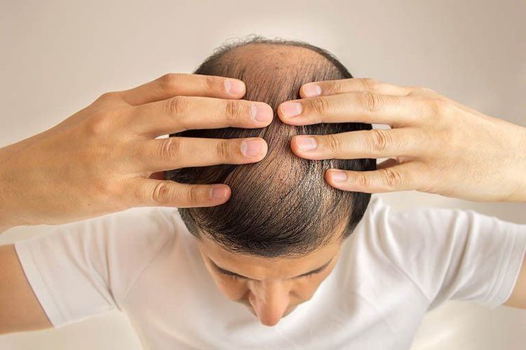 Thuốc Bequantene được sử dụng trong điều trị rụng tóc