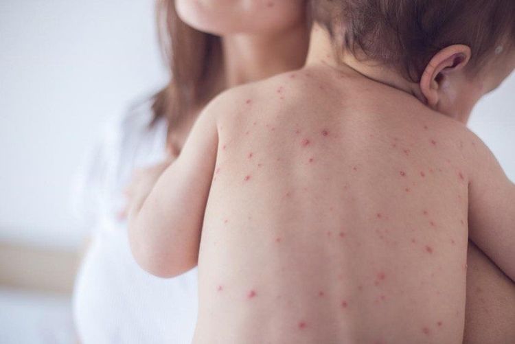 Viêm da dị ứng được coi là một trong những nguyên nhân làm cho trẻ phát ban không sốt