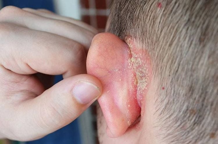 Ear eczema a condition characterized by eczema occurring on the ear, the external ear canal, and the skin around the ear.
