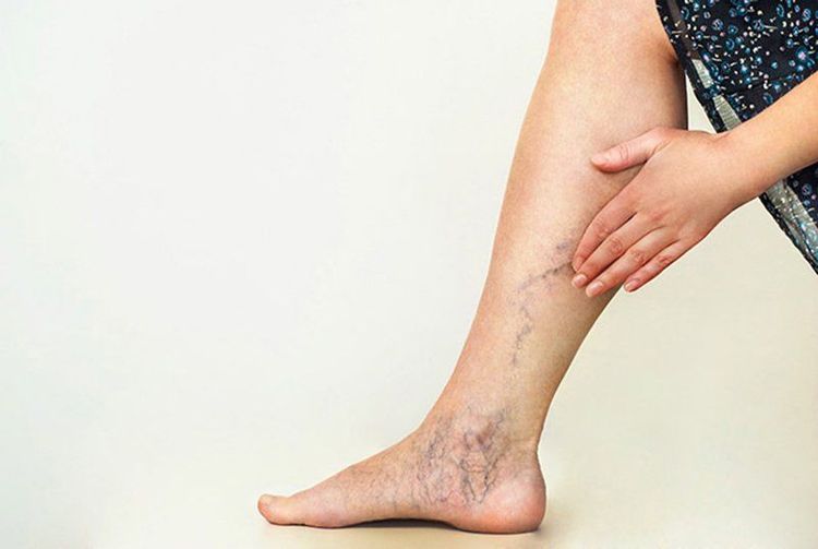 Bị giãn tĩnh mạch có nên massage hay không là vấn đề của nhiều người mắc bệnh
