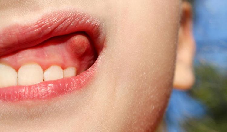 Mang thai bị đau răng có thể do tình trạng u hạt thai nghén
