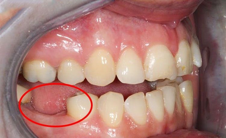 Mất răng có thể gây ra nhiều bệnh lý về răng miệng cho người bệnh