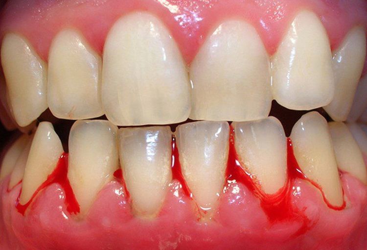 
Dụng cụ vệ sinh răng miệng của bạn có thể là nguyên nhân khiến nướu răng chảy máu
