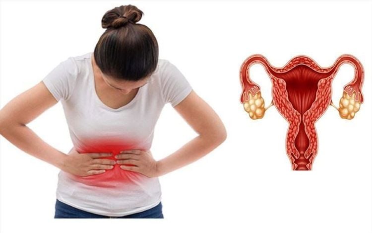 Cách chữa buồng trứng đa nang được nhiều người quan tâm