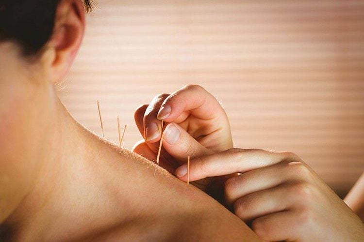 Phương pháp điều trị thoái hóa đốt sống cổ bằng châm cứu