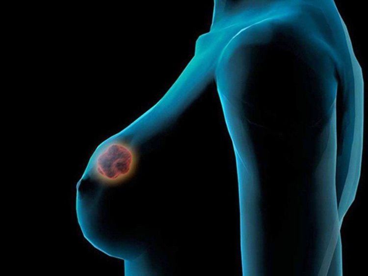 Trị viêm tuyến vú bằng bài thuốc từ cây thòng bong