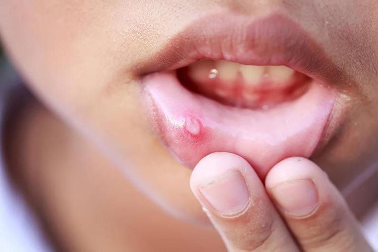 How to treat mouth ulcers in 1 day is sought by many people