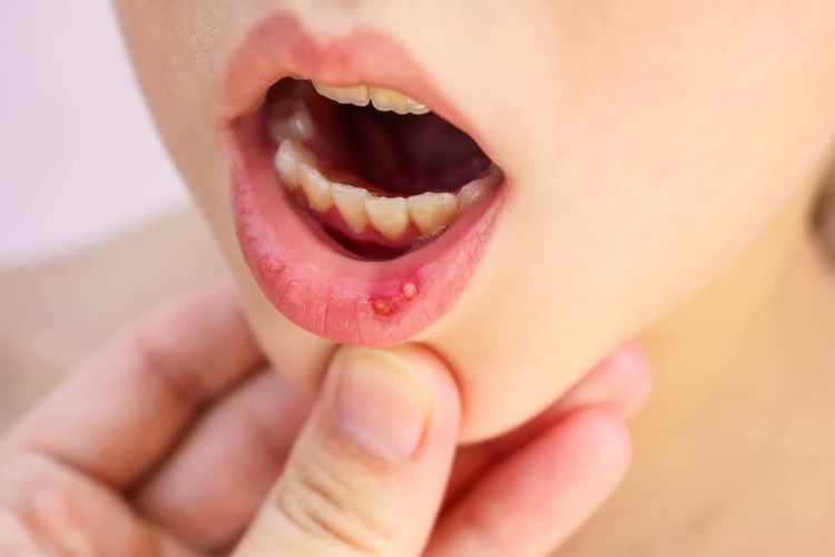 Trẻ bị nhiệt miệng có thể do nhiều nguyên nhân khác nhau gây ra