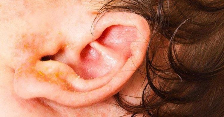 Yellow discharge from the ear lobe can be caused by several different conditions.