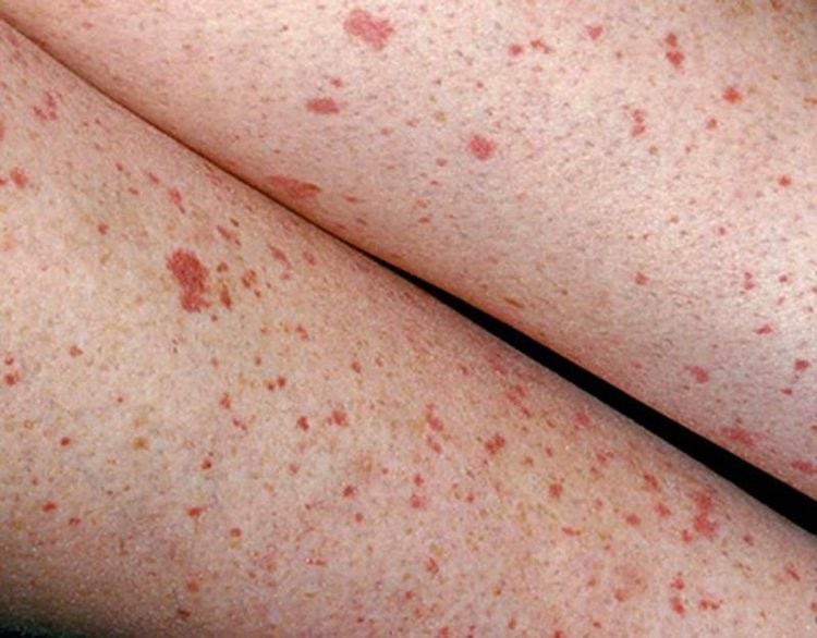 Many different causes can lead to subcutaneous hemorrhage