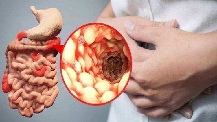 Các triệu chứng và biến chứng sẽ biểu hiện tùy thuộc vào nguyên nhân gây bệnh. 