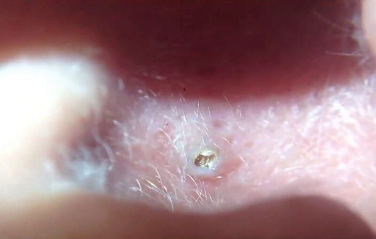 Ear acne occurs when bacteria obstruct the pores.
