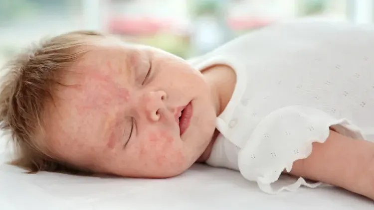 Hình ảnh bé bị dị ứng đạm sữa bò