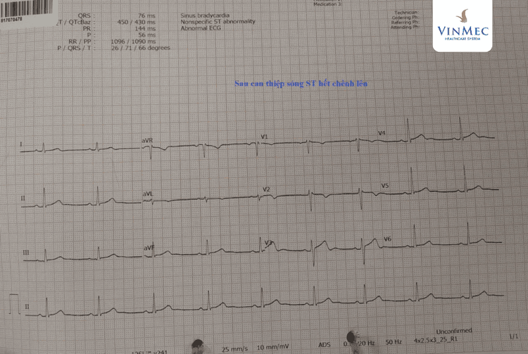 Chỉ số của bệnh nhân ổn định sau ca can thiệp tim mạch