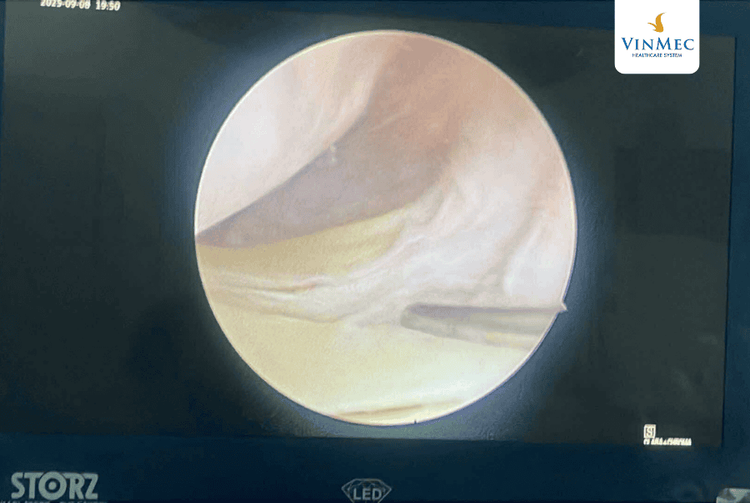 Hình ảnh camera nội soi phân giải cao được sử dụng trong phẫu thuật nội soi tái tạo dây chằng chéo trước tại bệnh viện Đa khoa Vinmec Hải Phòng