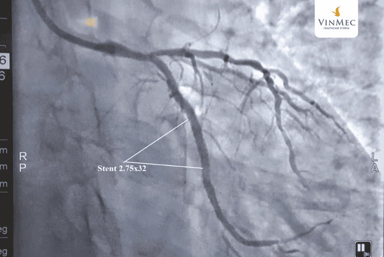 Hình ảnh stent được đặt vào động mạch LCX của bệnh nhân