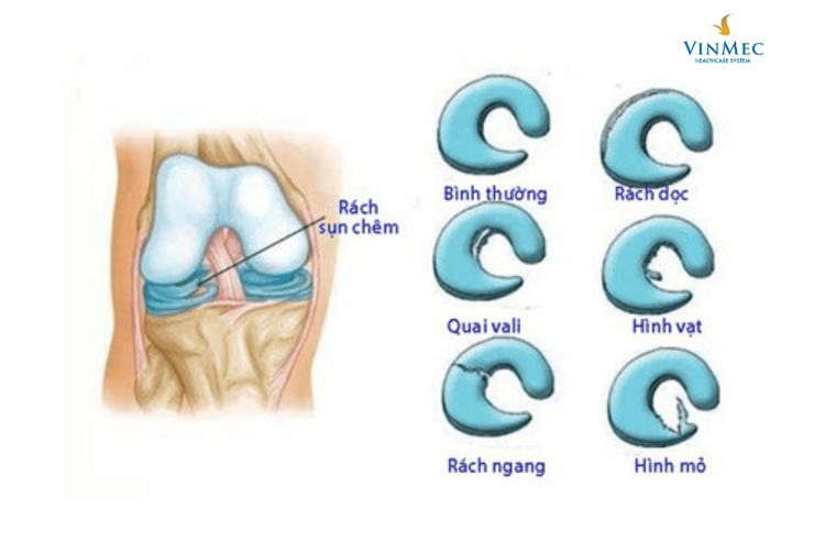 Các hình thái rách sụn chêm thường gặp