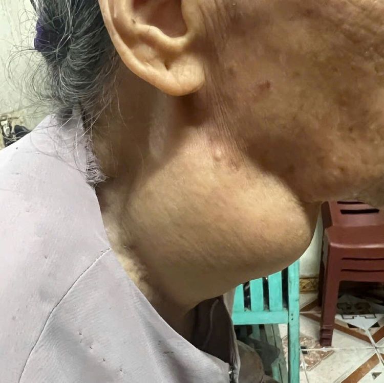 Khối u tuyến giáp khổng lồ gây khó khăn trong hít thở và sinh hoạt hàng ngày cho bệnh nhân
