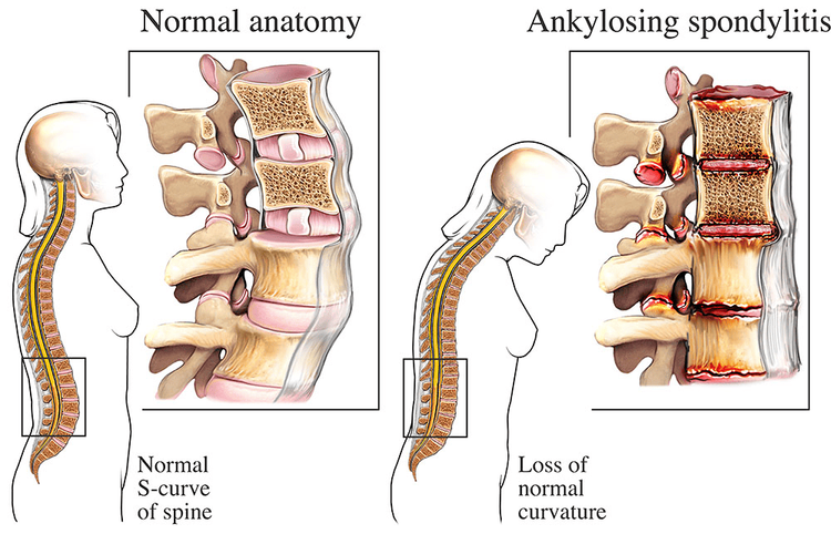 Bệnh viêm cột sống dính khớp ( Ankylosing Spondylitis) 