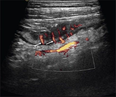 Quan sát theo chiều dọc của hồi tràng cuối trong bệnh Crohn hồi tràng với Doppler năng lượng (đầu dò 10 MHz) “Dấu hiệu Comb”: các mạch mạc treo song song là dấu hiệu của tình trạng viêm nặng (Điểm Limberg 4) (mũi tên)