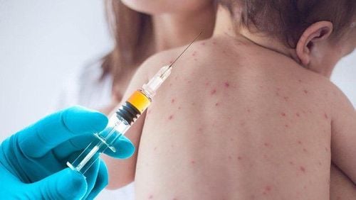 Cách phòng tránh sởi bệnh học hiệu quả và lâu dài nhất vẫn là tiêm phòng vắc xin sởi