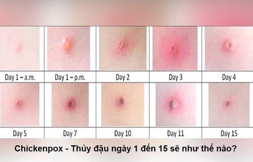Nhấn vào ảnh để phóng to
Hình ảnh nốt mụn nước thủy đậu qua từng ngày