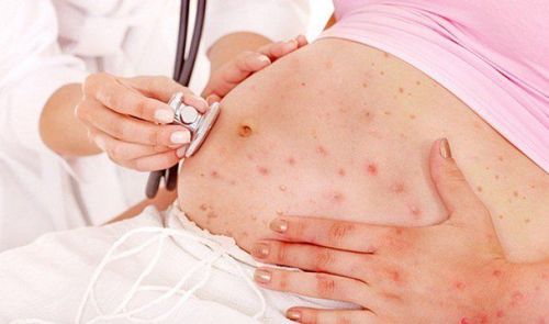 Nhấn vào ảnh để phóng to
Mẹ bầu khi mang thai mà mắc bệnh thủy đậu cần khám chữa kịp thời