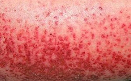 Phát ban là một trong các triệu chứng sốt xuất huyết ở người lớn
