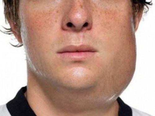 The etiological agent of mumps is the Paramyxovirus.