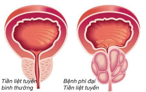 Kích thước tiền liệt tuyến 55x34x43mm có nguy hiểm không?