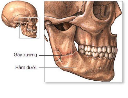 Gãy 1/3 xương hàm dưới ít nguy hiểm hơn
