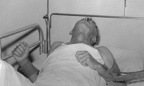 There are two clinical forms of rabies.

