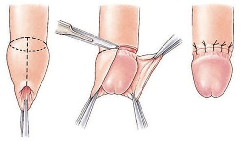 If you are not circumcised, pull the foreskin back before putting on a condom