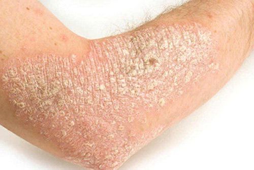 Hơn 75% trường hợp xuất hiện bệnh vẩy nến trước 40 tuổi.