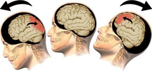 Người bệnh chấn thương sọ não nhẹ có thể xuất hiện nhiều triệu chứng khác nhau