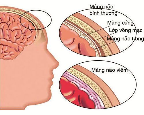 Bệnh viêm màng não do não mô cầu