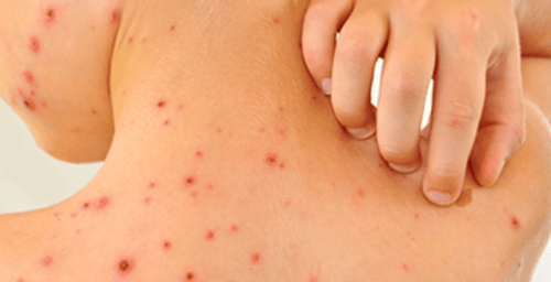 
Xuất huyết là một trong những triệu chứng của bệnh
