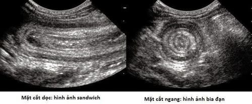 
Ultrasound image of intestinal intussusception
