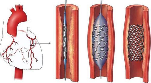 Đặt stent mạch vành