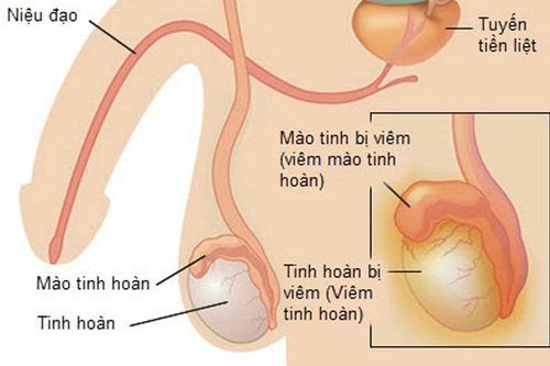 If your testicles feel soft and swollen, this could indicate an infection in the epididymal tubes caused by bacteria or viruses