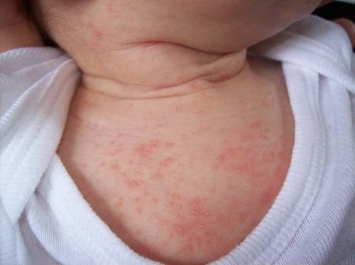 Bé 14 ngày tuổi nổi nốt đỏ li ti ở tay, cổ và lưng có nên đi khám không?