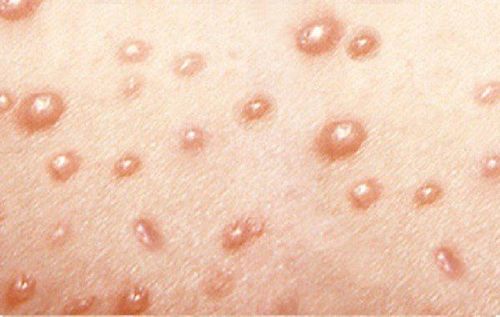 Patients with chickenpox need to pay attention to skin care
