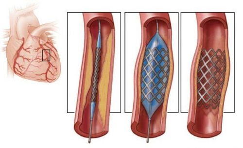 Kỹ thuật nong mạch vành và đặt stent là kỹ thuật ít xâm lấn hơn so với phẫu thuật bắc cầu động mạch vành